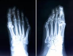 Healthy foot alignment vs deformation